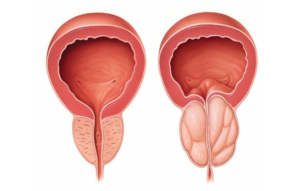 normal ug inflamed prostate