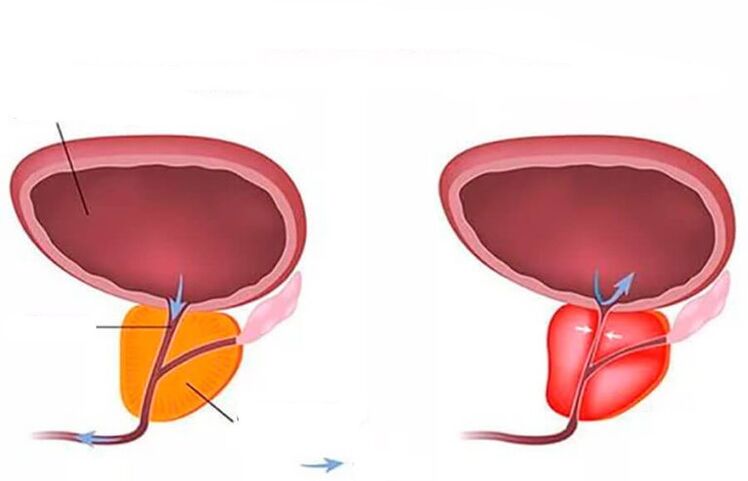 normal ug inflamed prostate