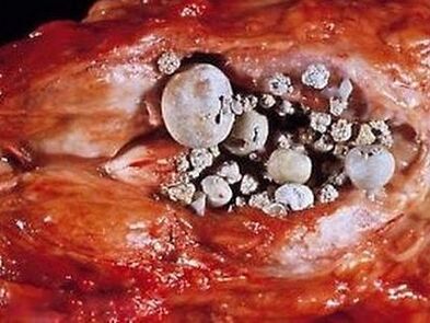 Mga bato sa prostate gland nga adunay calculous prostatitis