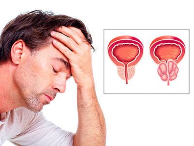 Sintomas sa prostatitis kabalaka sa usa ka tawo