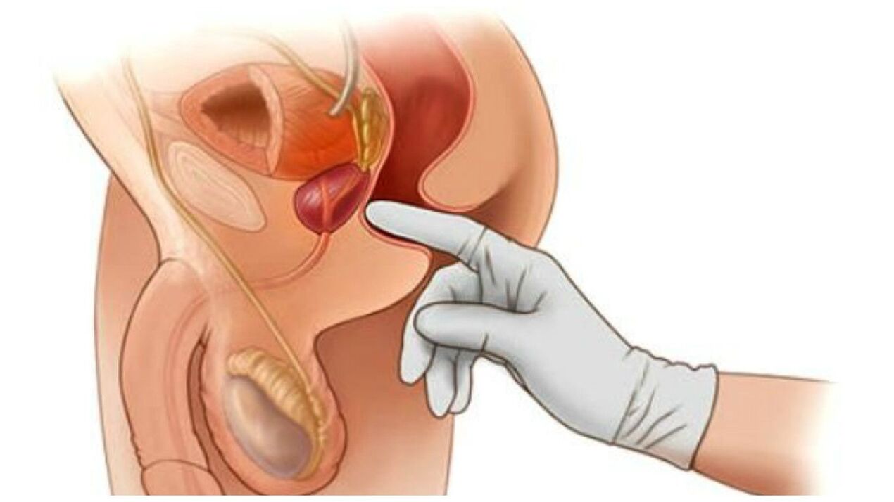 pagmasahe sa prostate