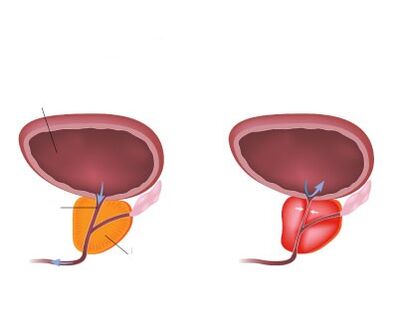 Normal ug inflamed prostate